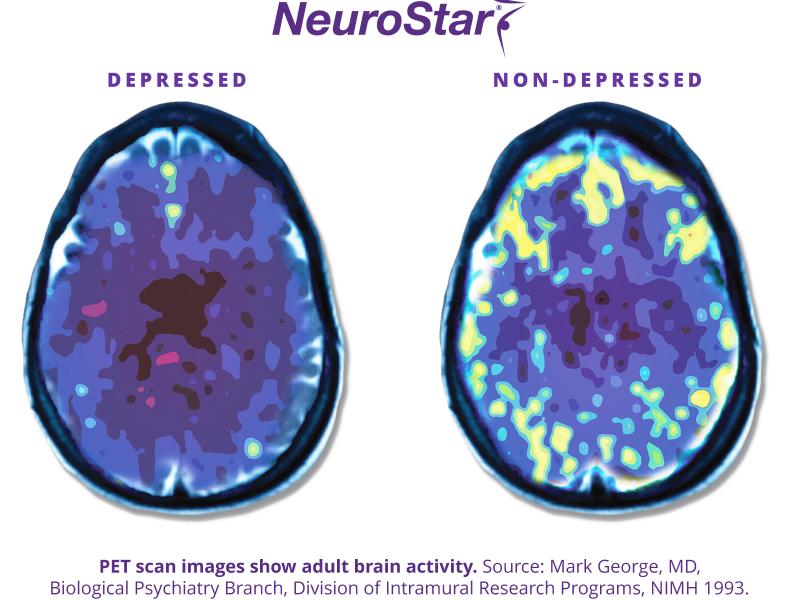 Brain with and without depression