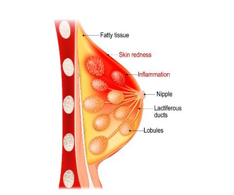 Breast Pain