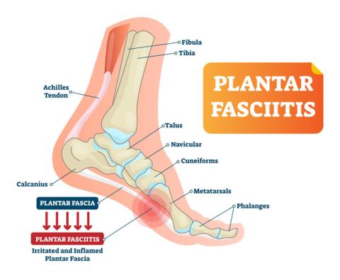 Plantar Fasciitis Diagram