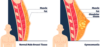 Gynecomastia illustration