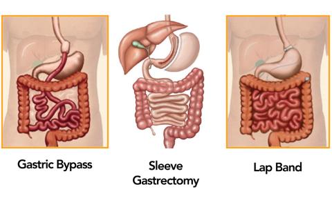 Revision Surgery Options