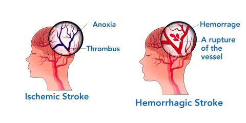 Ischemic and Hemorrhagic Strokes together