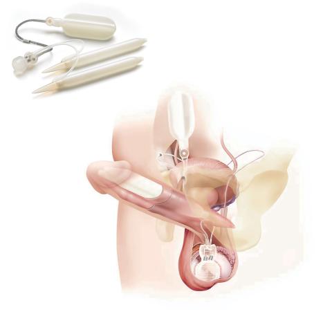 Titan Touch Inflatable Penile Implant